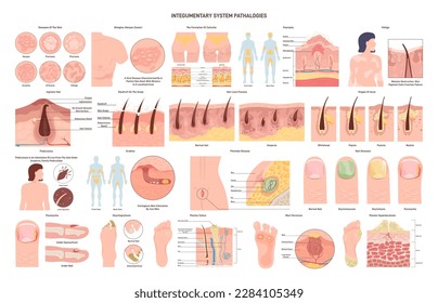 Integumentary system pathologies set. Skin, glands, hair, nail disorders and medical conditions. Virus, bacterial, hormonal and parasitic dermatology disease. Flat vector illustration