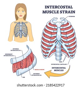 Intercostal muscle strain as muscular group in chest cavity outline diagram. Labeled educational medical scheme with skeleton and lungs muscle for ribcage respiratory movement vector illustration.