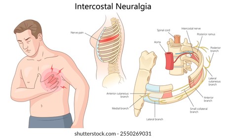 intercostal neuralgia, nerve pain in the chest with labeled intercostal nerve branches and anatomy diagram hand drawn schematic vector illustration. Medical science educational illustration