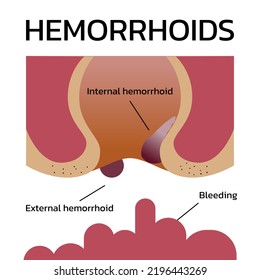 Internal And External Hemorrhoids With Bleeding Infographic