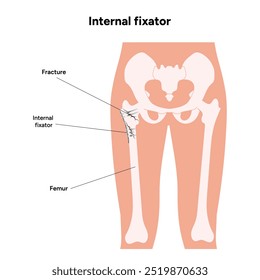 Fixação interna para fraturas ósseas