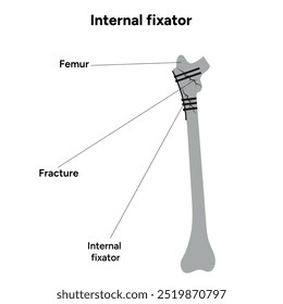 Fixação interna para fraturas ósseas	
