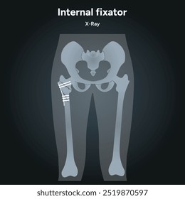 Fixação interna para radiografia de fraturas ósseas	
