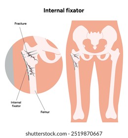 Fixação interna para zoom ósseo de fraturas