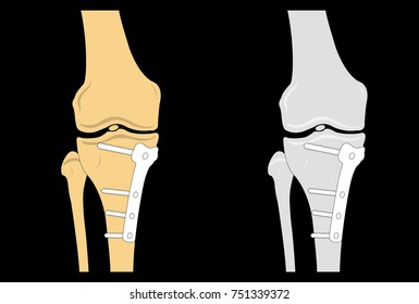 Internal Fixation of Fractures, Plate and Screws Vector illustration svg
