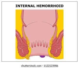 INTERNAL HEMORRHOID VECTOR COLOR SCHEME