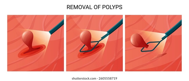 Internal organ polyp removal. Vector medical infographic for endoscopic removal of pollips.