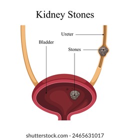 internal organ vector diagram of kidney stone disease