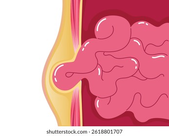 Internal organs abnormal condition, Choked Hernia, Umbilical hernia, Medical poster