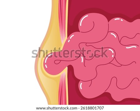 Internal organs abnormal condition, Choked Hernia, Umbilical hernia, Medical poster