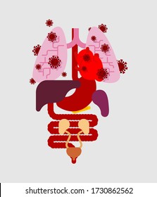 Órganos internos afectados por el coronavirus. Virus y bacterias ardientes. Enfermedad humana. Epidemia de coronavirus en el mundo. Brote Pandémico Covid-19. Desastre mundial