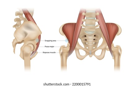 Internal snapping hip  Syndrome. Psoas major, Iliopsoas muscle and Snapping area