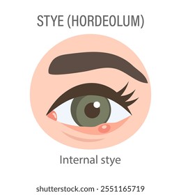 Estilo interno del ojo. Concepto médico de orzuelo, dolor ocular, infección bacteriana, enfermedad ocular. Ilustración plana, Anuncio de infografía