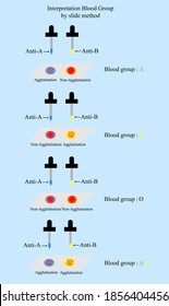 Interpretation blood group in ABO System by slide method in laboratory
