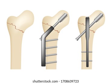 Intertrochanteric fracture of bone vector / white background