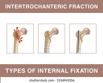 Intertrochanteric fracture. Types of internal fixation. Vector illustration showing the strengthening of the bone fracture using screws, rods, pins, or plates. svg