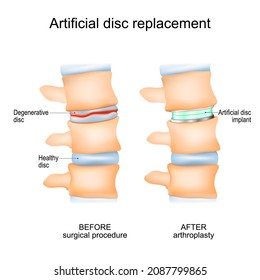 Intervertebral disc arthroplasty. Close-up of a human spinal column before Surgical procedure and after Arthroplasty. Degenerative Disc and Artificial disc replacement. Vector poster