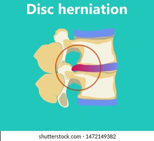 An intervertebral disc herniation flat illustration. Inflamed disc causing pain and discomfort. Degenerative process in spine. Educational medical information.