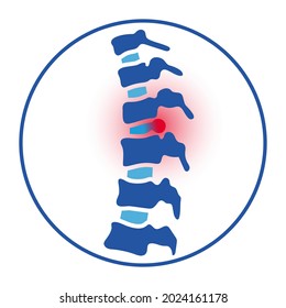 Intervertebral hernia logo. Spine disease, backbone with herniated disc, therapy and treatment in spine clinic. Spinal pain and diagnosis. Human vertebrae anatomy isolated medical vector illustration.