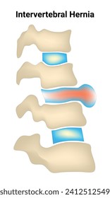 Intervertebral Hernia Science Design Vector Illustration