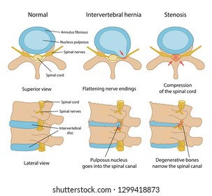 Intervertebral hernia and Spinal stenosis with main description. Healthy disc and discs with intervertebral hernia and Spinal stenosis in superior and lateral views. Vector illustration