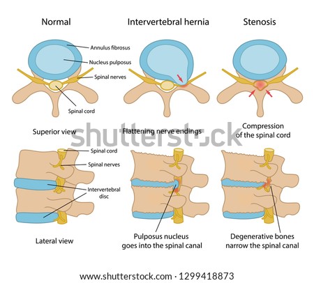 Intervertebral hernia and Spinal stenosis with main description. Healthy disc and discs with intervertebral hernia and Spinal stenosis in superior and lateral views. Vector illustration