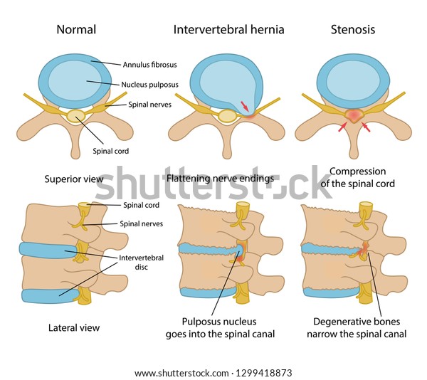 Intervertebral Hernia Spinal Stenosis Main Description Stock Vector