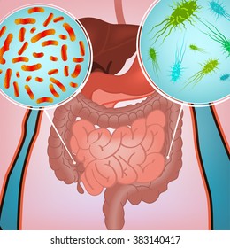 Imagen de infección intestinal
