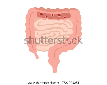Intestinal Polyps Disease Clip Art