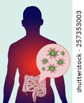 Intestinal virus infection.