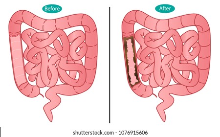 The intestines are clean and not clean