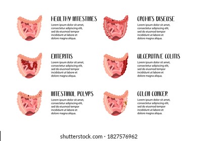 Intestines diseases. Enteritis, ulcerative colitis, Crohn's disease, polyp, colon cancer. Gastroenterology. Vector flat illustration. Perfect for flyer, medical brochure, banner, landing page, website