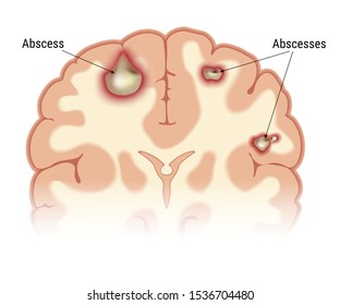 Intracerebral abscess of the human brain in the context. Visual image of the location of foci of infectious inflammation. Isolated on a white background. Vector graphics.