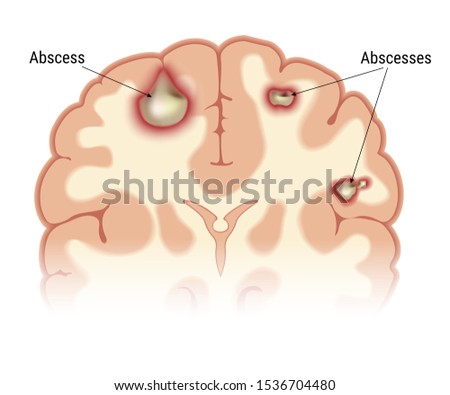 Intracerebral abscess of the human brain in the context. Visual image of the location of foci of infectious inflammation. Isolated on a white background. Vector graphics.