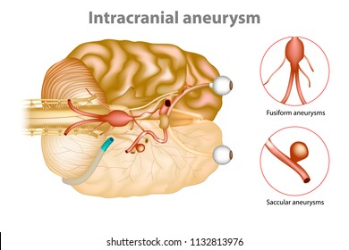 Intracranial Aneurysm Or Brain Aneurysm.