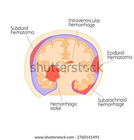 Intracranial hematomas illustration showing types of brain bleeding inside the skull. Includes epidural, subdural, subarachnoid, intracerebral, and intraventricular hematomas. Educational medical concept for anatomy and neurology.