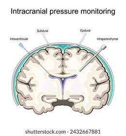 Intracranial pressure. ICP monitoring. Cross section of a human brain. localizations of pressure probes or catheters. Epidural, subdural, parenchymal,  intraventricular. Surgical techniques in trauma