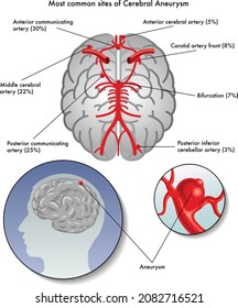 intracranial vessels aneurysm capillaries brain anatomy anatomical biological course