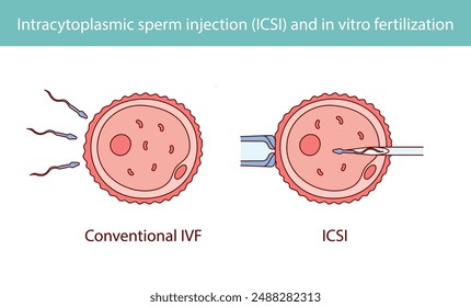 Intracytoplasmic sperm injection (ICSI) and in vitro fertilization hand drawn in line style