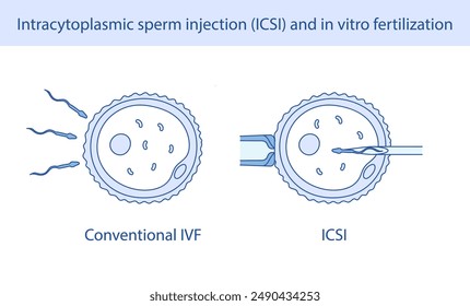 Inyección intracitoplásmica de espermatozoides (ICSI) y fertilización in vitro dibujada a mano en estilo lineal