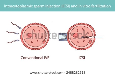 Intracytoplasmic sperm injection (ICSI) and in vitro fertilization hand drawn in line style