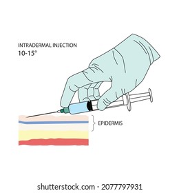 Intradermal injection. Effective methods of administration of drugs and other medical solutions that are used for humans and animals. Vector illustration isolated on white background.