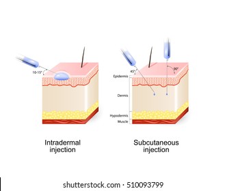 Intradermal Subcutaneous Injection Angle Depth Injections Stock Vector ...