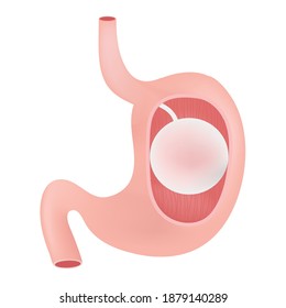 The gastric balloon (endoscopic intragastric balloon) 