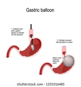 Intragastric Balloon. Gastric Balloon Inside a Stomach. inflatable medical device that is temporarily placed into the stomach to reduce weight. Human anatomy. Vector diagram for medical use