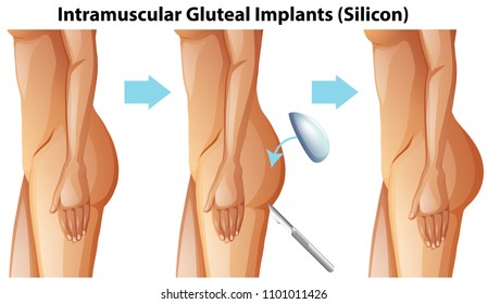 Intramuscular Gluteal Implants on White Background illustration