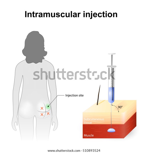 Intramuscular Injection Angle Depth Injections Technique Stock Vector ...