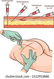 Intramuscular injection vector illustration and   Comparison of the angles of intramuscular injection.