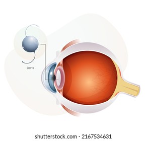 Intraocular Lens for Human Eye with Cataract - Illustration as EPS 10 File