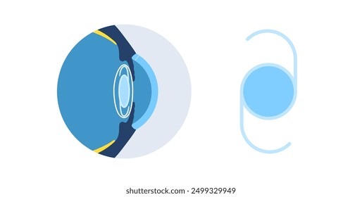 Cartel de implantación de lentes intraoculares. Tratamiento de cataratas, ojo sano con LIO. Visión corta o hipermetropía. Anatomía del sistema visual humano. Ilustración vectorial anatómica de cataratas.